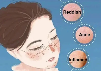 ceramide powder anti-inflammatory ceramide powder anti-inflammatory